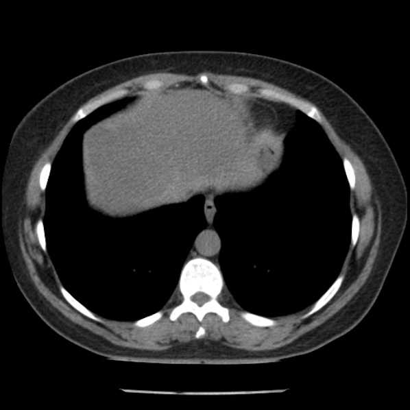 Adrenal myelolipoma (Radiopaedia 43401-46759 Axial non-contrast 8).jpg