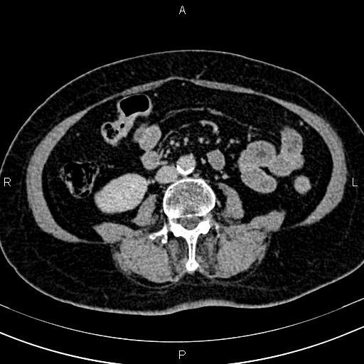 Adrenal myelolipoma (Radiopaedia 82742-96986 Axial renal excretory phase 87).jpg