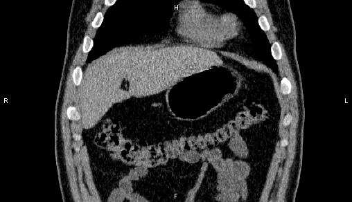 Adrenal myelolipoma (Radiopaedia 84321-99619 Coronal non-contrast 13).jpg
