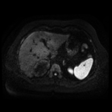 File:Adrenal myelolipoma - MRI (Radiopaedia 83249-97646 Axial DWI 7).jpg