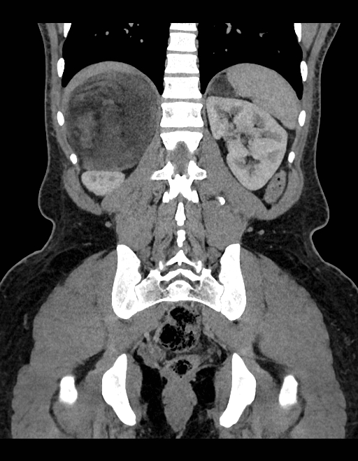 Adrenal myelolipoma - bilateral (Radiopaedia 74805-85810 Coronal C+ portal venous phase 101).jpg