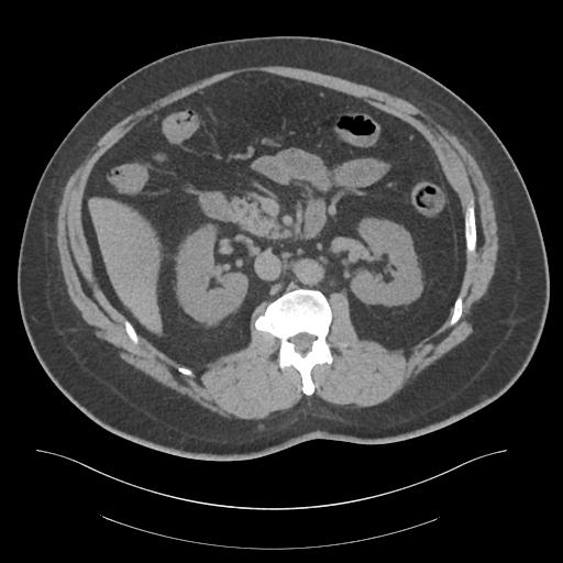 File:Adrenal vein sampling and adrenal nodular hyperplasia - Conn syndrome (Radiopaedia 30561-31337 Axial non-contrast 36).jpg