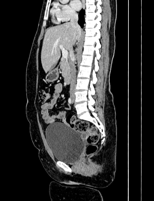 Adrenocortical carcinoma (Radiopaedia 87281-103569 Sagittal C+ portal venous phase 138).jpg