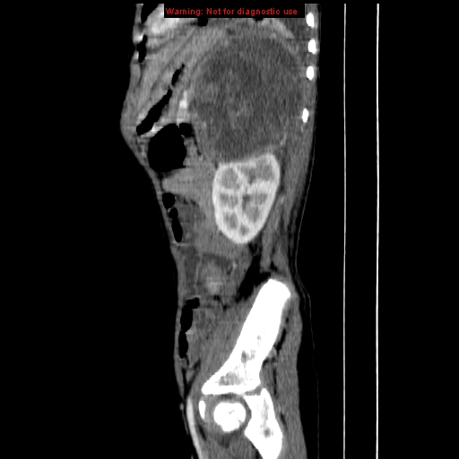 File:Adrenocortical carcinoma (Radiopaedia 9449-10131 Sagittal C+ portal venous phase 14).jpg