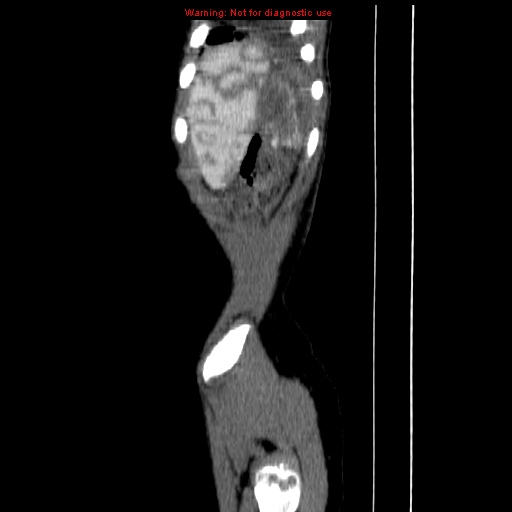 File:Adrenocortical carcinoma (Radiopaedia 9449-10131 Sagittal C+ portal venous phase 20).jpg