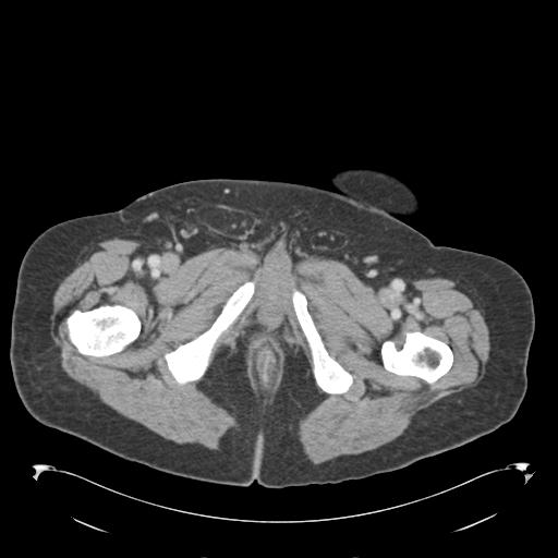 Adult ileal intussusception with secondary obstruction (Radiopaedia 30395-31051 Axial C+ portal venous phase 84).jpg