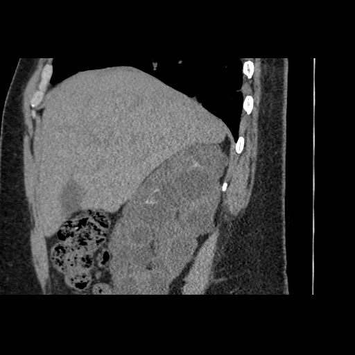 Adult polycystic kidney disease (Radiopaedia 59075-66368 Sagittal non-contrast 13).jpg