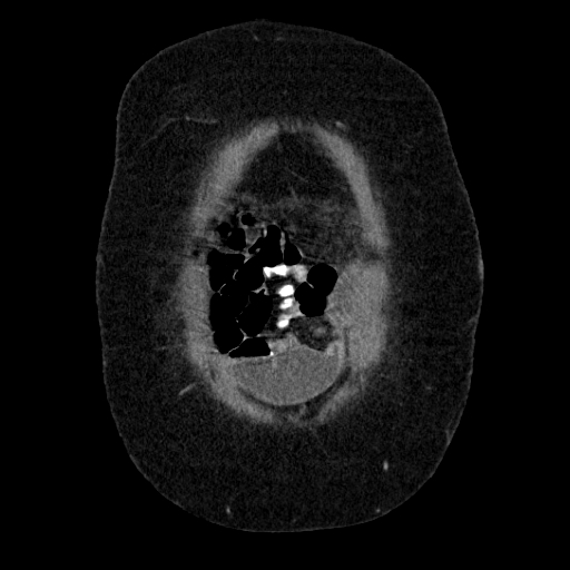File:Afferent loop syndrome - secondary to incarcerated trocar site hernia (Radiopaedia 82959-97305 Coronal C+ portal venous phase 29).jpg