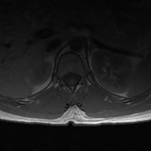 File:Aggressive vertebral hemangioma (Radiopaedia 39937-42404 Axial T1 5).png