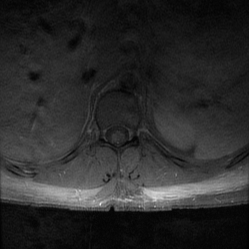 File:Aggressive vertebral hemangioma (Radiopaedia 39937-42404 Axial T1 C+ fat sat 8).png