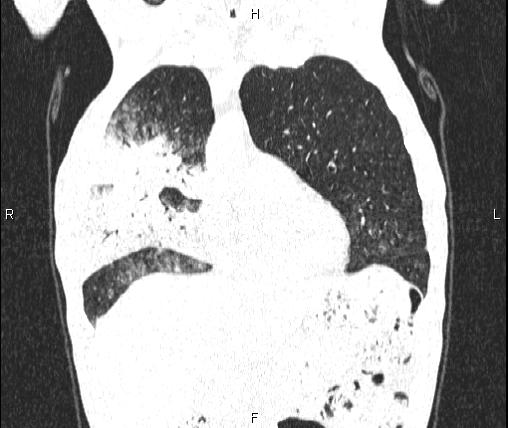Air bronchogram in pneumonia (Radiopaedia 85719-101512 Coronal lung window 17).jpg