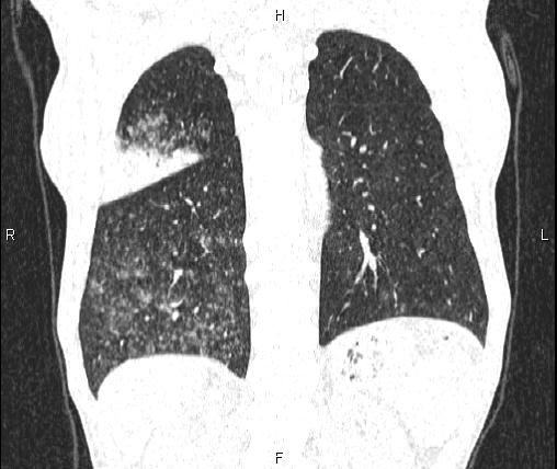 File:Air bronchogram in pneumonia (Radiopaedia 85719-101512 Coronal lung window 45).jpg