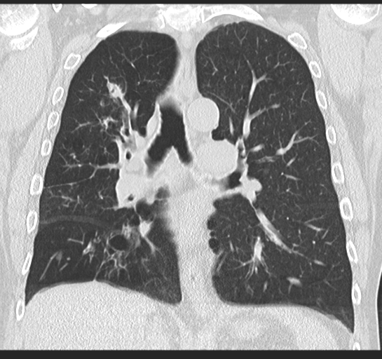 Allergic bronchopulmonary aspergillosis (Radiopaedia 44760-48571 Coronal lung window 32).png