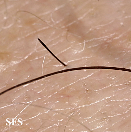 Alopecia Areata (Dermatology Atlas 62).jpg