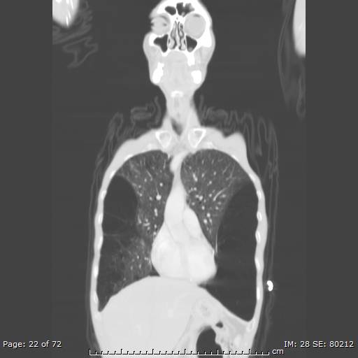 Alpha-1-antitrypsin deficiency (Radiopaedia 50561-55987 Coronal lung window 20).jpg