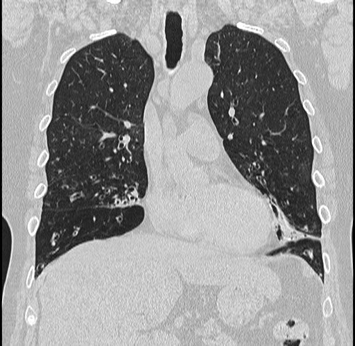 Alpha-1-antitrypsin deficiency (Radiopaedia 72058-82557 Coronal lung window 28).jpg