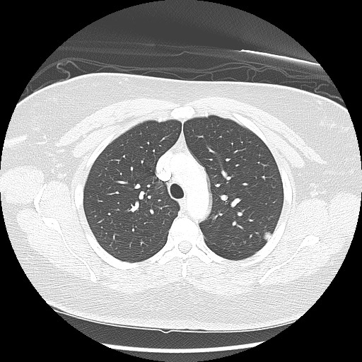 Alveolar soft part sarcoma - right leg (Radiopaedia 59432-67091 Axial lung window 34).jpg