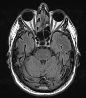 File:Alzheimer's disease- with Gerstmann syndrome and dressing apraxia (Radiopaedia 54882-61150 Axial FLAIR 8).png