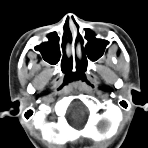 File:Ameloblastoma (Radiopaedia 26645-26793 Axial C+ delayed 33).jpg