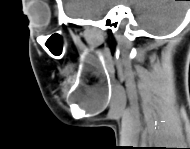File:Ameloblastoma (Radiopaedia 26645-26793 Sagittal C+ delayed 9).jpg