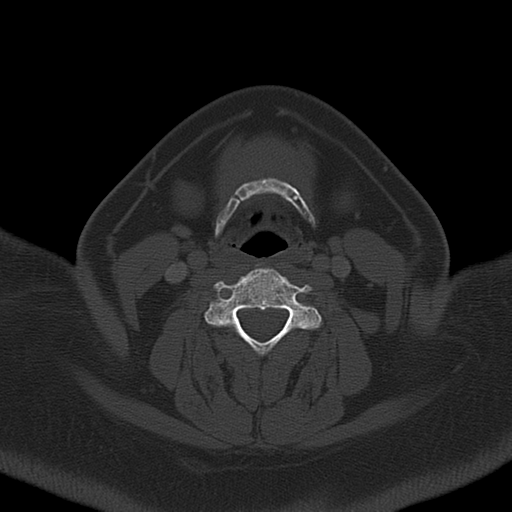 Ameloblastoma (Radiopaedia 38520-40623 Axial bone window 44).png