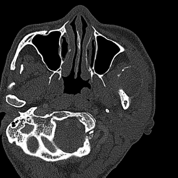 Ameloblastoma (Radiopaedia 51921-57766 Axial bone window 128).jpg