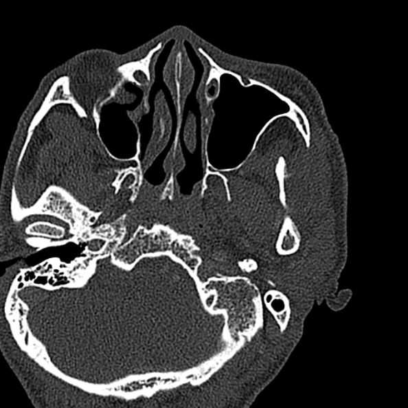 Ameloblastoma (Radiopaedia 51921-57766 Axial bone window 141).jpg