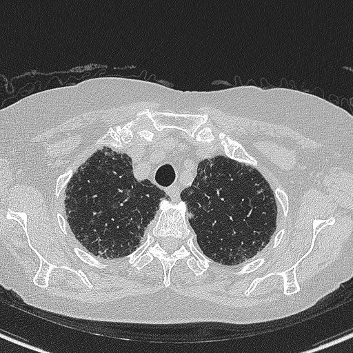 Amiodarone-induced pulmonary fibrosis (Radiopaedia 82355-96460 Axial lung window 13).jpg