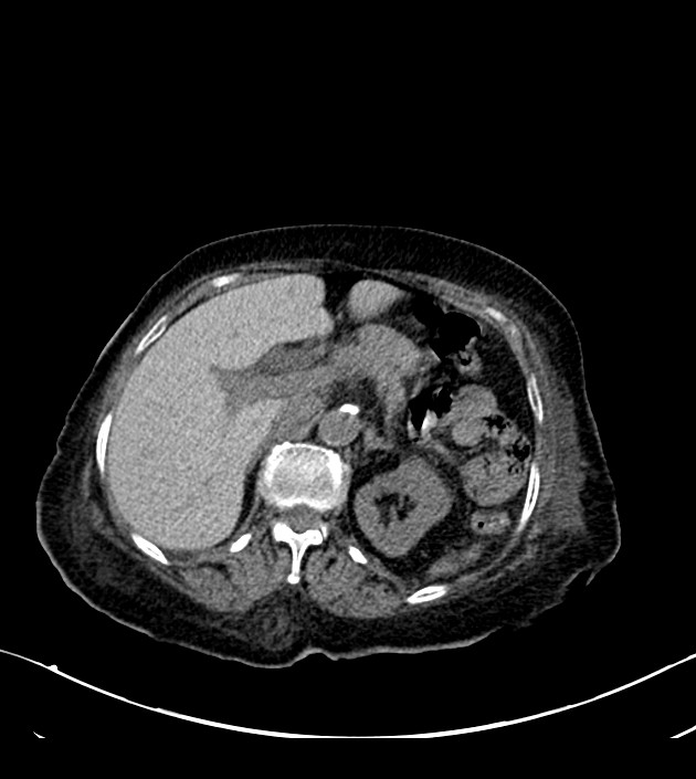 Amiodarone deposition in the liver (Radiopaedia 77587-89780 Axial non-contrast 88).jpg