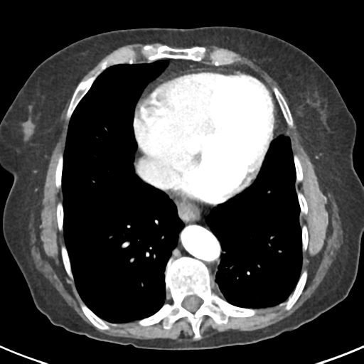 Ampullary adenocarcinoma (Radiopaedia 34013-35237 B 2).png