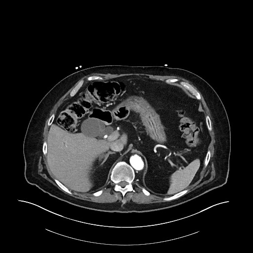 File:Ampullary adenocarcinoma (Radiopaedia 59373-66734 Axial 13).jpg