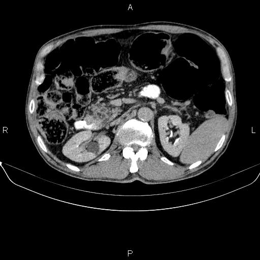 Ampullary adenocarcinoma (Radiopaedia 86093-102032 Axial C+ delayed 36).jpg