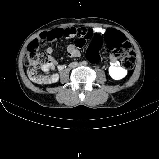 Ampullary adenocarcinoma (Radiopaedia 86093-102032 Axial C+ delayed 63).jpg