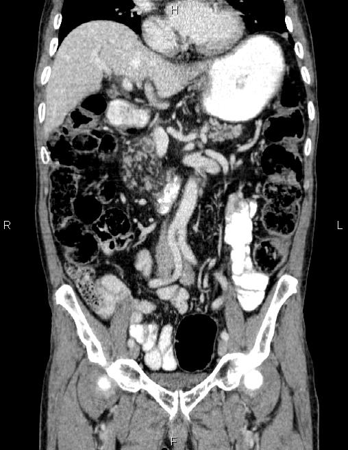 Ampullary adenocarcinoma (Radiopaedia 86093-102032 C 30).jpg
