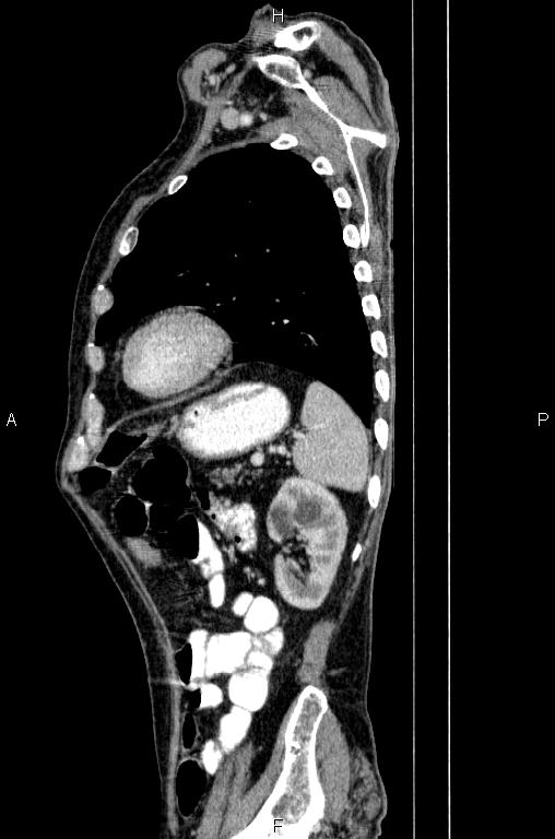 Ampullary adenocarcinoma (Radiopaedia 86093-102033 E 72).jpg