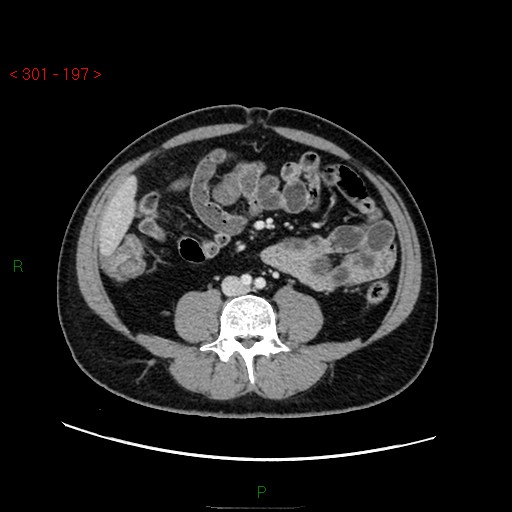 Ampullary carcinoma (Radiopaedia 56396-63056 C 59).jpg