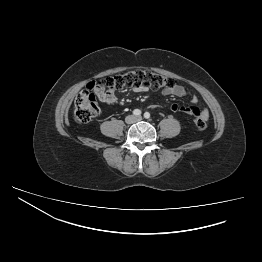 Ampullary tumor (Radiopaedia 60333-67998 A 53).jpg