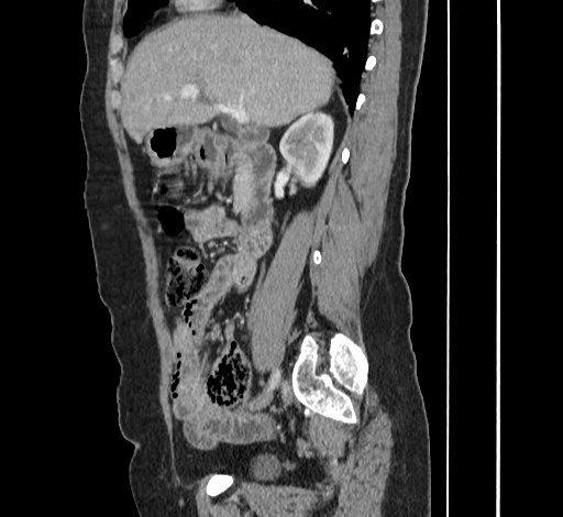 File:Ampullary tumor (Radiopaedia 60333-67998 C 20).jpg