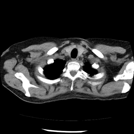 Amyloidosis - bronchial and diffuse nodular pulmonary involvement (Radiopaedia 60156-67744 Axial non-contrast 6).jpg