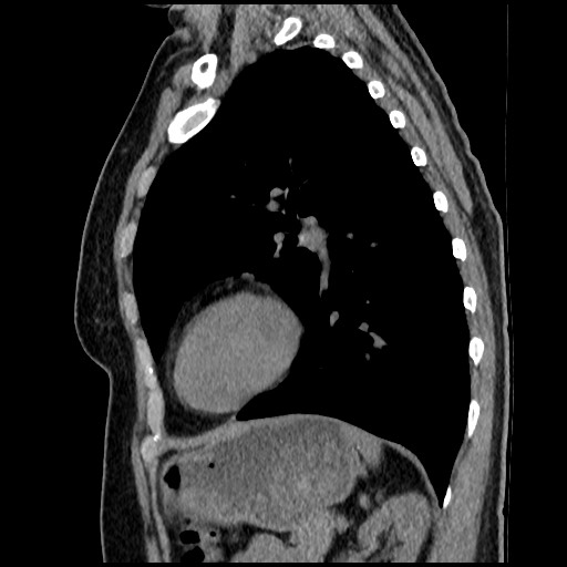 Amyloidosis - bronchial and diffuse nodular pulmonary involvement (Radiopaedia 60156-67744 E 39).jpg