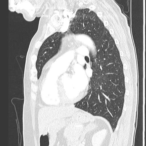 Amyloidosis - bronchial and diffuse nodular pulmonary involvement (Radiopaedia 60156-67745 Sagittal lung window 56).jpg