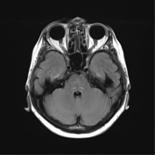 File:Anaplastic astrocytoma (Radiopaedia 86943-103160 Axial FLAIR 9).png