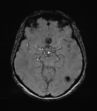 Anaplastic astrocytoma (Radiopaedia 86943-103160 Axial SWI 39).png