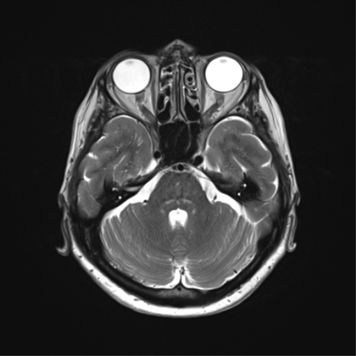 File:Anaplastic astrocytoma (Radiopaedia 86943-103160 Axial T2 13).png