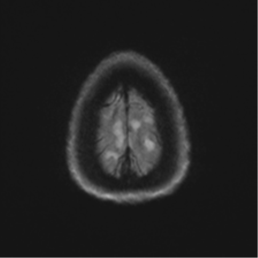 Anaplastic astrocytoma - thalamic glioma (Radiopaedia 59709-67115 Axial DWI 68).png