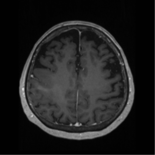 File:Anaplastic astrocytoma IDH wild-type (pseudoprogression) (Radiopaedia 42209-45276 Axial T1 C+ 105).png