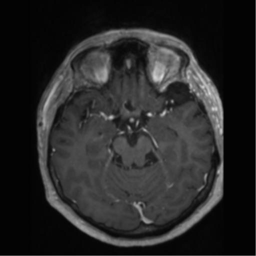 File:Anaplastic astrocytoma IDH wild-type (pseudoprogression) (Radiopaedia 42209-45277 Axial T1 C+ 45).png