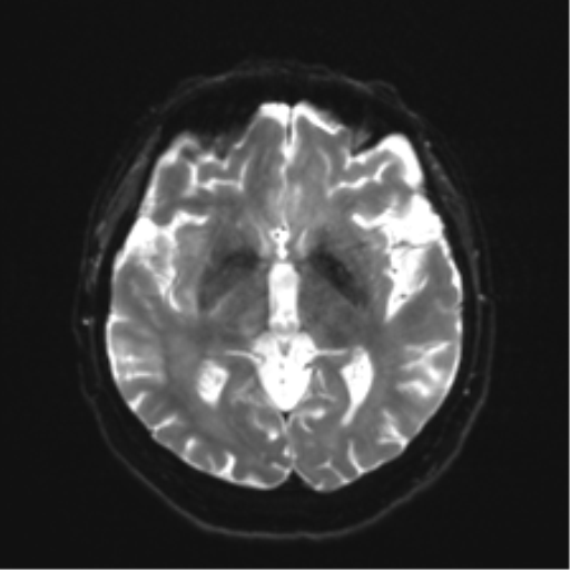 File:Anaplastic astrocytoma IDH wild-type (pseudoprogression) (Radiopaedia 42209-45279 Axial DWI 13).png
