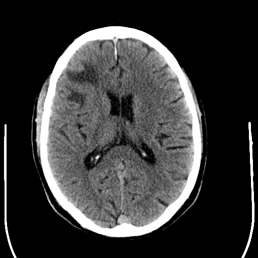 File:Anaplastic meningioma with recurrence (Radiopaedia 34452-35781 Axial non-contrast 19).png