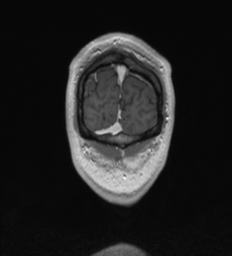 Anaplastic oligodendroglioma (Radiopaedia 37667-39563 Coronal T1 C+ 92).png